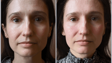 Image for Facial Reshaping